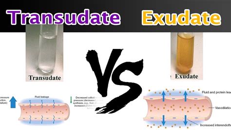 refractometry vs transudate